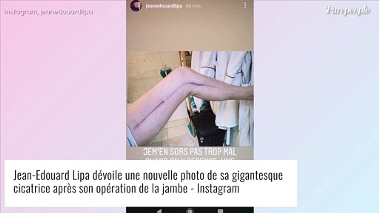 Jean-Edouard Lipa et son énorme cicatrice : souvenir d'une amputation évitée de justesse