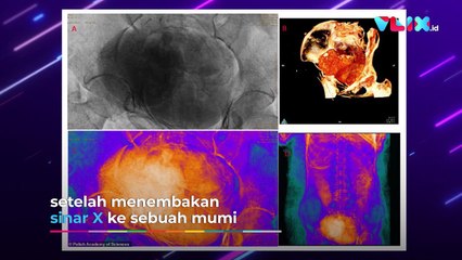 Pertama di Dunia! Arkelog Polandia Temukan Mumi Ibu Hamil