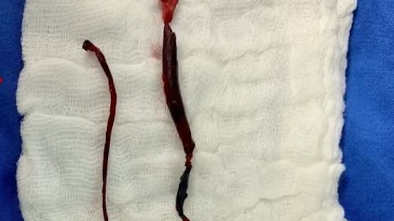 Is Covid triggering blood clotting? Doctor, who removed it from a Covid patient, explains