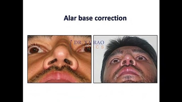 Nose (Rhinoplasty) Surgery Before And After Images - Real Nose Job Photos - Dr Y V Rao Clinics