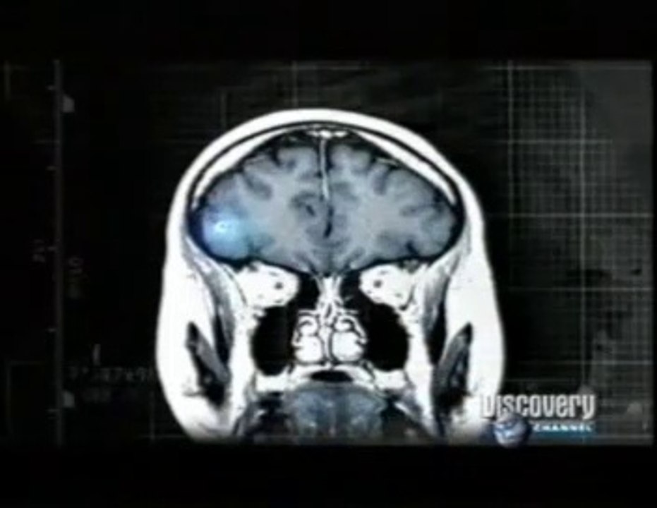 Neurocisticercosis: Larvas de tenia en el cerebro