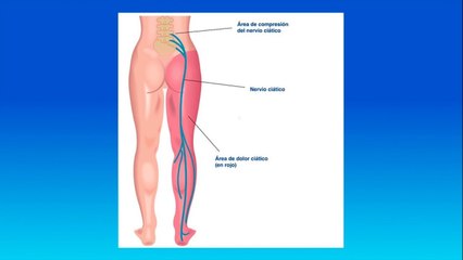 bd-como-tratar-el-dolor-de-nervio-ciatico-120521