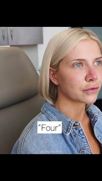 4 Months Post Very Complex Primary Rhinoplasty With @Charles & Alyssa Forever  ✨