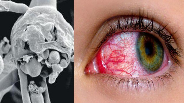 Corona Virus Patients को Black Fungus से खतरा, Eyes के लिए बेहद खतरनाक | Boldsky
