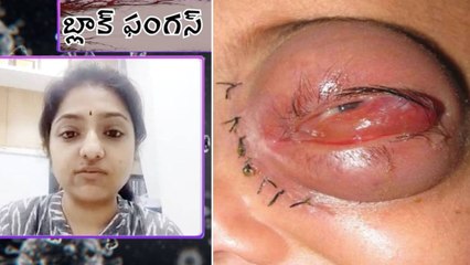 Black Fungus Alert -స్టెరాయిడ్స్ వాడకంలో ప్రోటోకాల్ ఉండాలి.. బ్లాక్ ఫంగస్ నియంత్రణ | PART 2