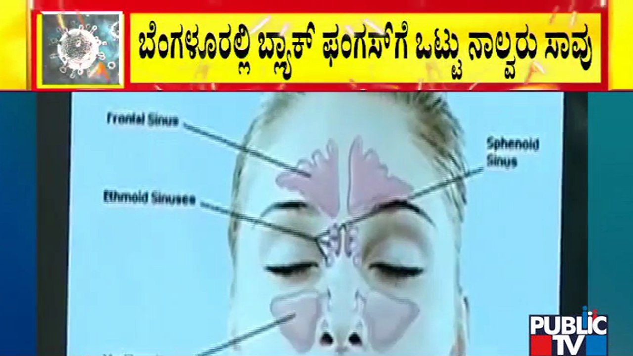 ಕೋವಿಡ್ ಸೋಂಕಿತರಿಗೆ ಬ್ಲ್ಯಾಕ್ ಫಂಗಸ್ ಕಾಟ; ಬೆಂಗಳೂರಲ್ಲಿ ಬ್ಲ್ಯಾಕ್ ಫಂಗಸ್ ಗೆ ನಾಲ್ವರು ಬಲಿ | Black Fungus