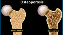 bd-fracturas-de-cadera-por-osteoporosis-180521
