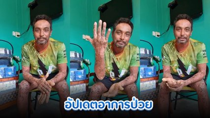 วินัย ไกรบุตร อัปเดตอาการป่วยล่าสุด โรคตุ่มน้ำพอง