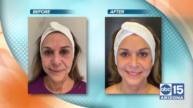 Turn Back Time Spa & Wellness Clinic demonstrates their new skin resurfacing treatment called Coolpeel