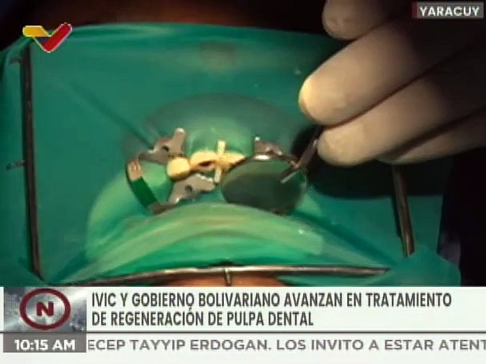 Yaracuy | Misión Sonrisa y el IVIC realizan tratamiento con células madre a 50 pacientes
