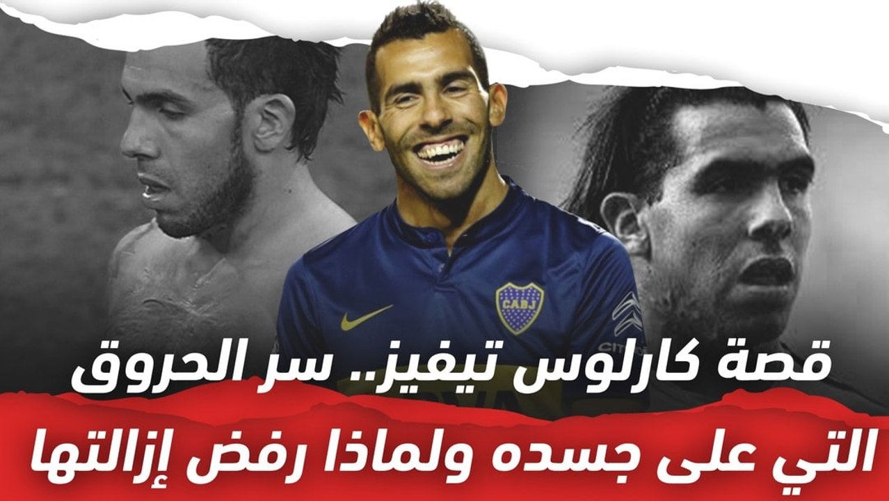 قصة كارلوس تيفيز..  سر الحروق التي على جسده ولماذا رفض إزالتها