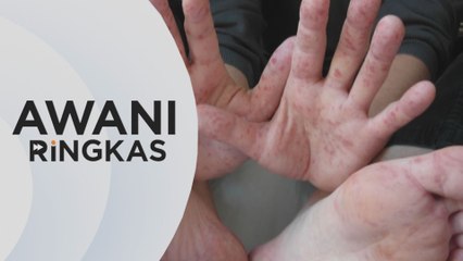 AWANI Ringkas: Kes HFMD naik 32 kali ganda