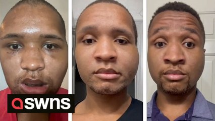 California man makes extraordinary recovery after breaking EVERY bone in his face when falling from three-storey balcony