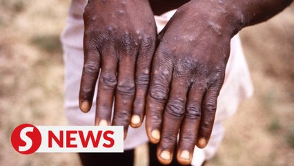 Khairy: Malaysia has strategic plan to combat monkeypox