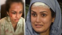 Karan Mehra के दिए चोट को प्लास्टिक सर्जरी से ठीक करवाएगी Nisha Rawal | FilmiBeat