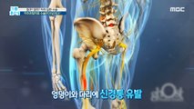 [HEALTHY] Changes on my spine! Spinal stenosis, surgery is the only answer?, 기분 좋은 날 210604