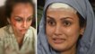 Karan Mehra की Wife Nisha Rawal की चोट की क्या होगी Plastic Surgery ? | Boldsky
