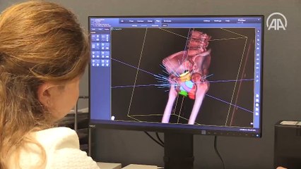 Robotik radyocerrahi cihazı 'Uzay Neşteri' kanser tedavisinde etkin rol üstleniyor