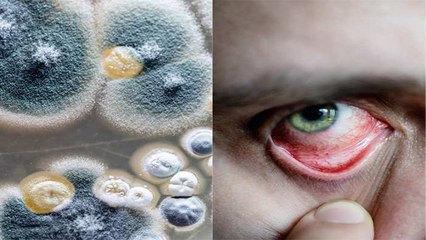 Coronavirus की Third Wave में इन लोगों में 'Black Fungus' का ज्यादा खतरा | Boldsky