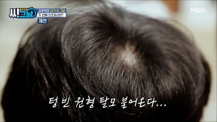 내가…내가…탈모라니…! 원형탈모를 부른 전조 증상 대 공개!