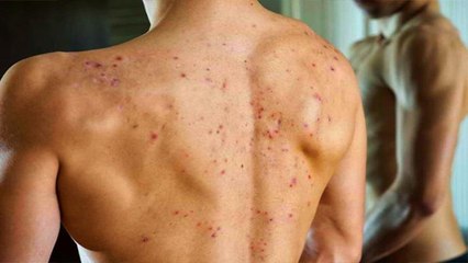 छोटी सी खरोंच भी बन सकती है जानलेवा, जान लें इस नई बीमारी के लक्षण ! | Boldsky