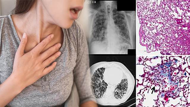 Post Covid Recovery बढ़ा Fibrosis का खतरा, Symptoms दिखते ही कराएं जांच | Boldsky