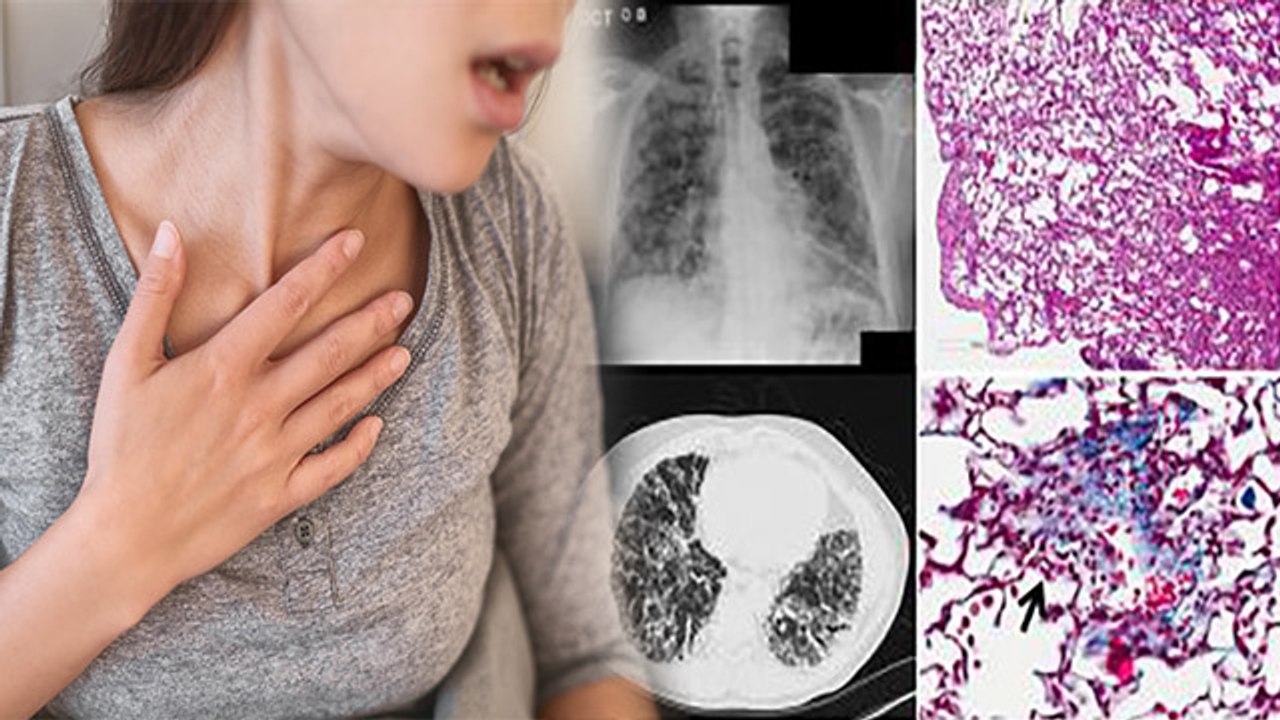 Post Covid Recovery बढ़ा Fibrosis का खतरा, Symptoms दिखते ही कराएं जांच | Boldsky