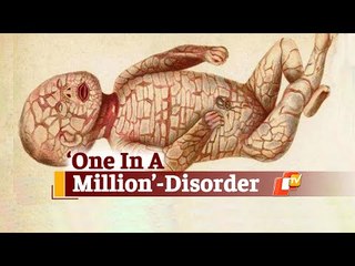 Baby In Odisha Born With Rare Harlequin Ichtyhyosis Disorder | OTV News