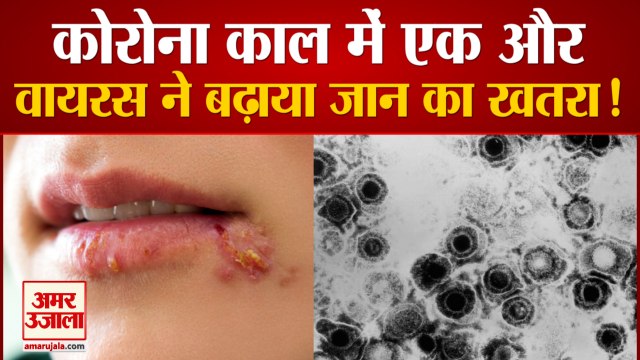 Herpes Simplex Virus | हर्पीज सिंप्लेक्स वायरस | HSP Virus found in Ghaziabad | Coronavirus