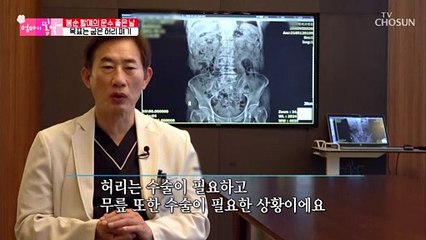 그저 감사합니다 시술 전·후가 확연히 다른 어머니의 허리☺ TV CHOSUN 20210613 방송