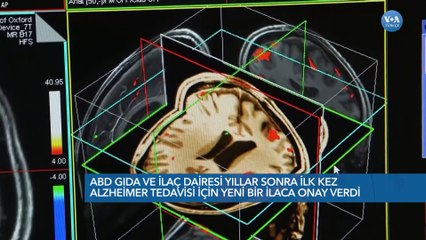 ABD'de Onay Verilen Alzheimer İlacı Neden Tartışmalı?