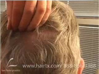 HAIR TRANSPLANT IN DALLAS:  TRICHOPHYTIC DONOR CLOSURE REDUX