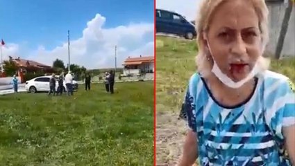 Sokak hayvanlarını beslediği için saldırıya uğrayan kadının çenesinde kırıklar oluştu