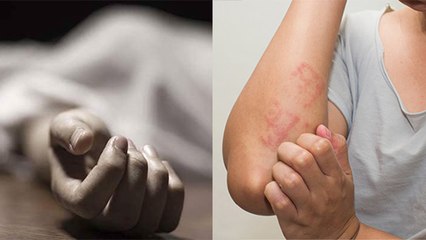 India में Vaccine के बाद हुई मौत का Reason, Anaphylaxis Symptoms क्या है | Boldsky