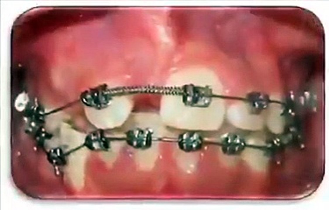 Comment un appareil dentaire corrige la dentition ?