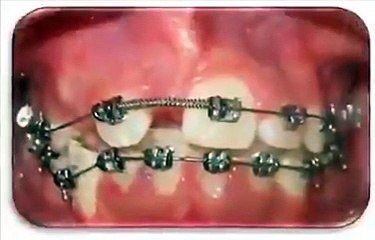 Comment un appareil dentaire corrige la dentition ?