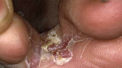 Fungal Infection से बचने के लिए अपनाएं ये तरीके, बारिश में है अधिक खतरा | Boldsky