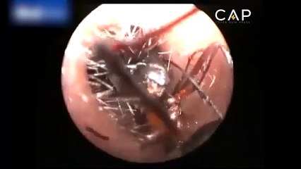 Küçük kızın kulağında karınca yuvası!