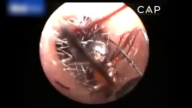 Küçük kızın kulağında karınca yuvası!