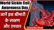 World Sickle Cell Awareness Day: जानें खून में पल रही इस बीमारी के बारे में सब कुछ । वनइंडिया हिंदी