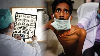 Post Covid Recovery के बाद TB का बढ़ा खतरा, Doctors से जानें कैसे बचें | Boldsky
