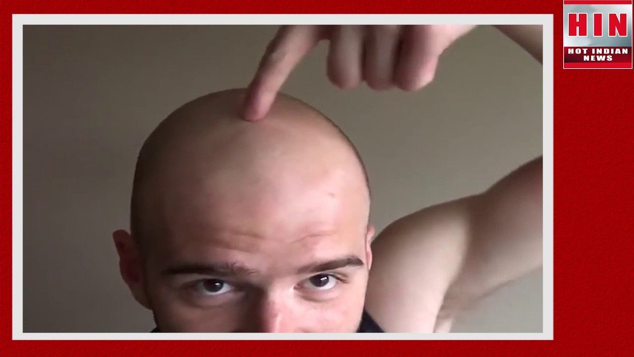 Hair transplant gone wrong ! हेयर ट्रांसप्लांट करने वाले हैं ! सावधान हो जाइये | HIN NEWS