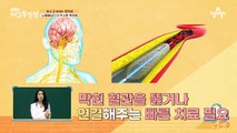 뇌졸중 환자의 편마비 후유증 발생 비율, 최대 88%?!