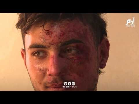 مقاتلين أكراد يتلقون العلاج بعد إصابتهم بحروق.. فهل استخدمت تركيا أسلحة محرمة في حربها ضد الأكراد؟
