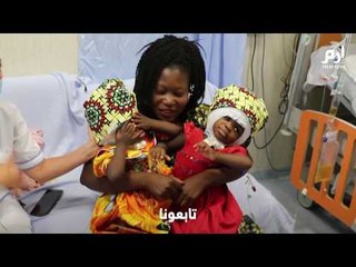 فصل توأمين سياميتين موصولتين في الجمجمة بنجاح  #إرم_نيوز