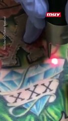 Tecnología láser para remover tatuajes.