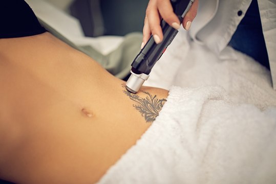 ¿Sabes cómo se quita un tatuaje? Te mostramos el proceso