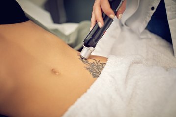 ¿Sabes cómo se quita un tatuaje? Te mostramos el proceso
