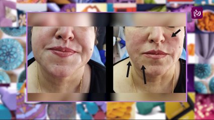 طرق شد الوجه والرقبة والذقن المزدوج بدون جراحة