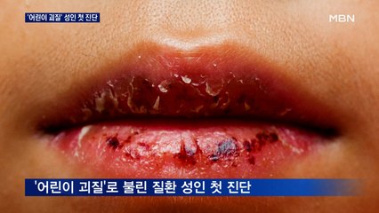 코로나19 확진 뒤 '어린이 괴질' 앓은 성인 첫 진단